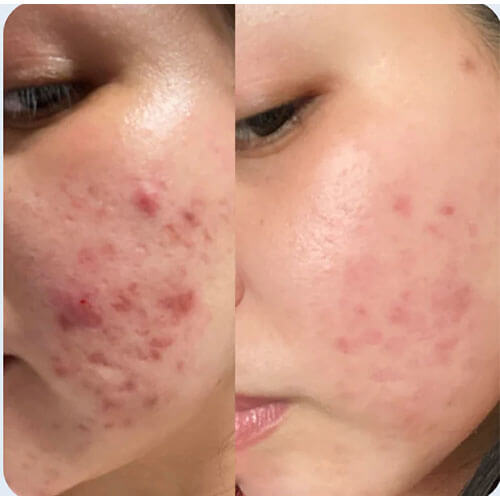 files/Acne_scars_before_and_after_kallistia_V4.jpg