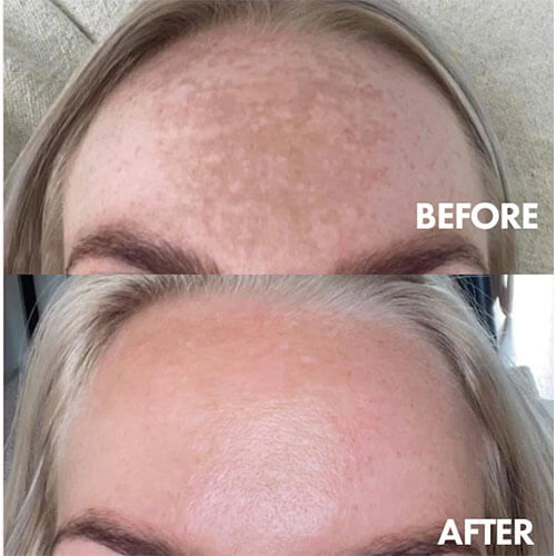 files/before_and_after_melasma_hyperpigmentation_v4_1.jpg